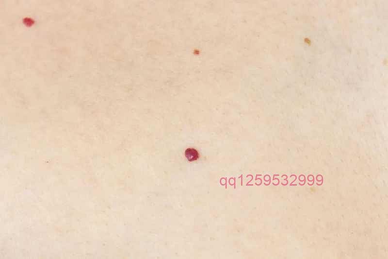 身上的小红点到底是什么？有些拖着不管可能病变-神人佛-善无痕蛇无泪